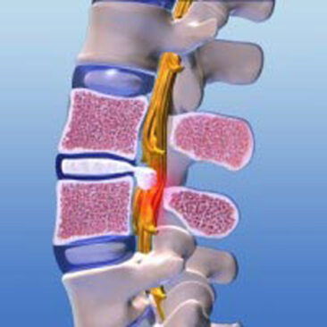 Minimalinvasive Bandscheibenoperation – eine Erfolgsgeschichte