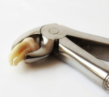 Entfernung der Weisheitszähne über 40 – ist das wirklich notwendig?