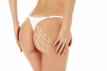 Po-Straffung ohne Operation mit Sculptra in der Dorow Clinic