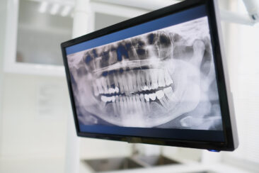 Präzise 3D-Bildgebung mit Hilfe der DVT – warum sinnvoll und wann nützlich?