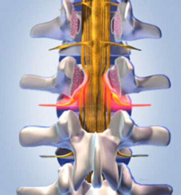 Spinalkanalstenose – Wann kann eine Operation Abhilfe schaffen?