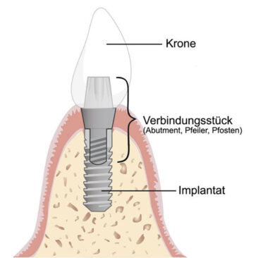 Entwicklungen bei den verschiedenen Implantat-Arten und was sind die Favoriten?