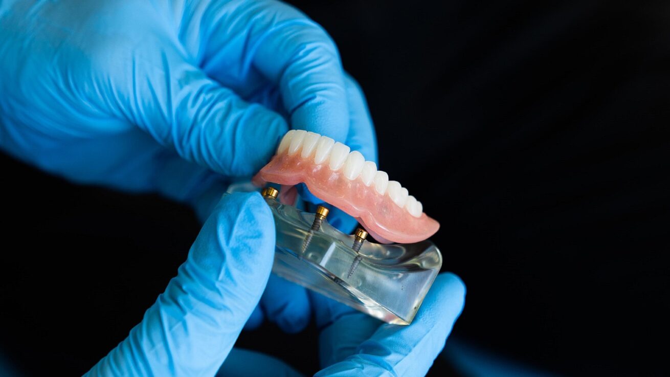 Gibt es Alternativen zu Implantaten mit denen sich ein Zahnimplantat vermeiden lässt?