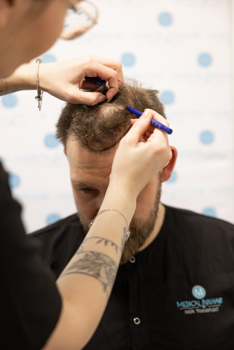 Haartransplantation Düsseldorf