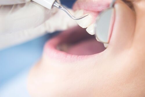 Zahnarzt Hamburg Wandsbek: Wie kann man Karies vorbeugen?