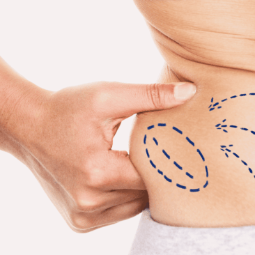 Fettabsaugung: Präzision statt radikale Diät