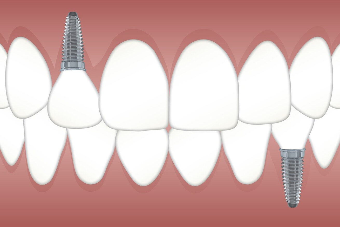Neue Zähne an einem Tag – wie geht das und wie haltbar sind diese neuen Implantate?