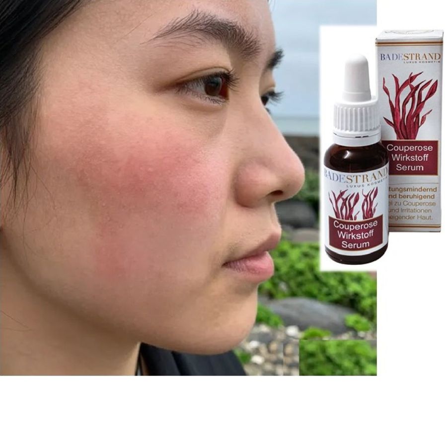 Rötungsmindernd & hautverbessernd – Couperose-Wirkstoff-Serum von Badestrand Kosmetik