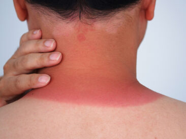 Sonnenbrand – Verbraucherinformation der DKV