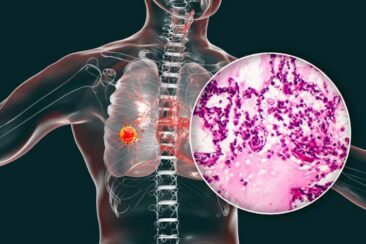 Lungenkrebs und das Immunsystem – neue Forschung stärkt die Hoffnung auf personalisierte Immuntherapien