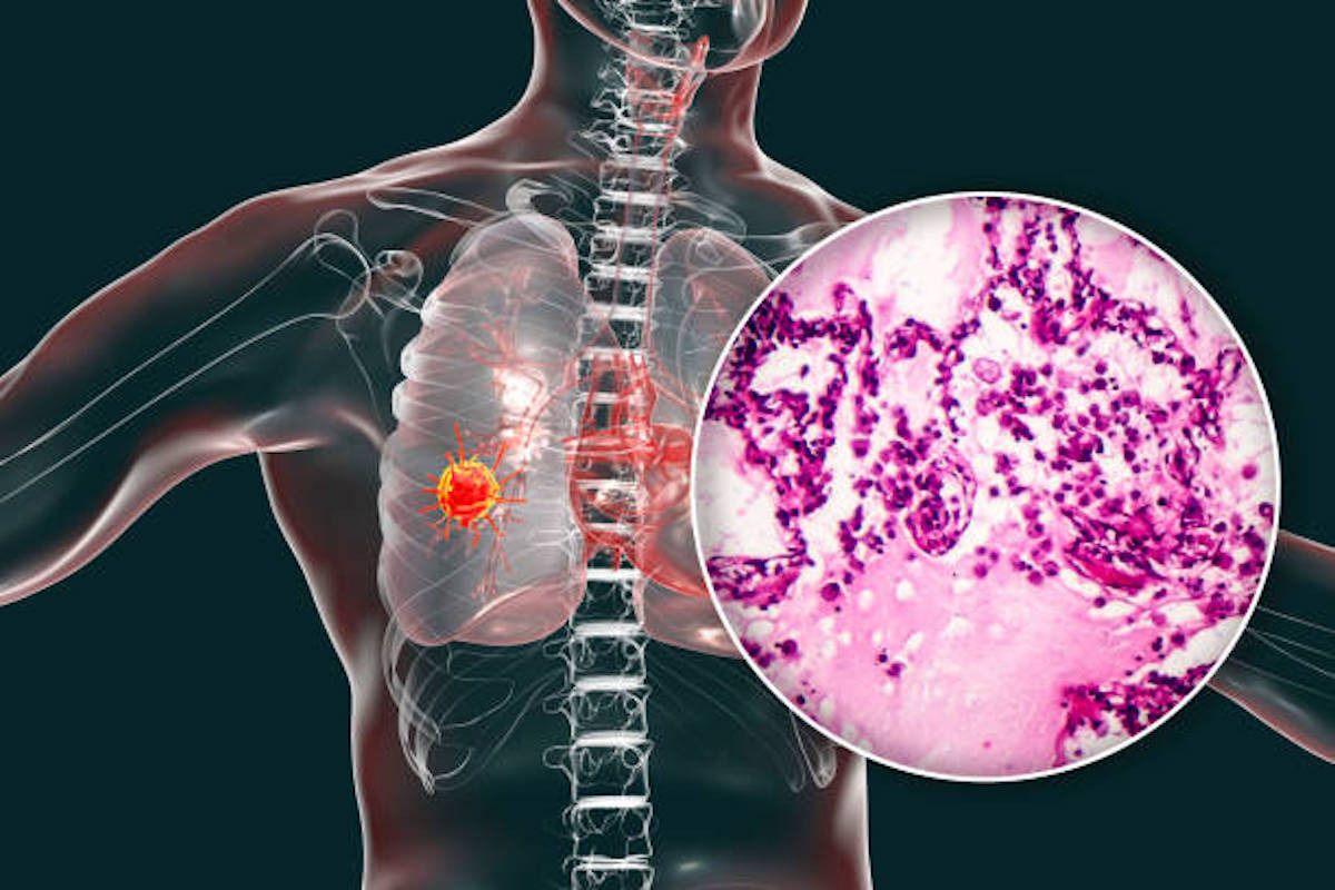Lungenkrebs und das Immunsystem – neue Forschung stärkt die Hoffnung auf personalisierte Immuntherapien