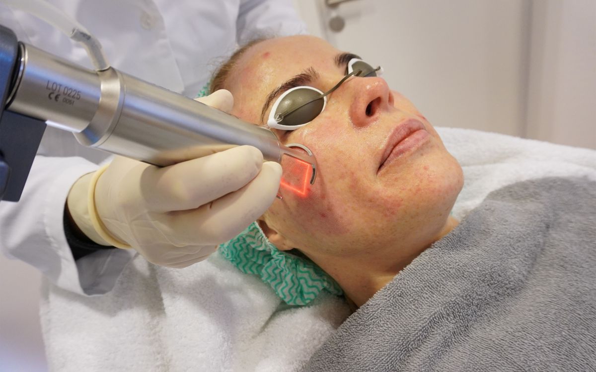 Fraktionierter CO?-Laser in Düsseldorf: Schonende Hautverjüngung & Narbenbehandlung durch erfahrene Fachärzte