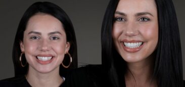 Veneers – Perfektion im Zehntelmillimeter