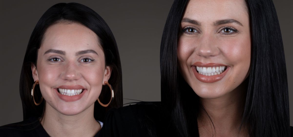 Veneers – Perfektion im Zehntelmillimeter